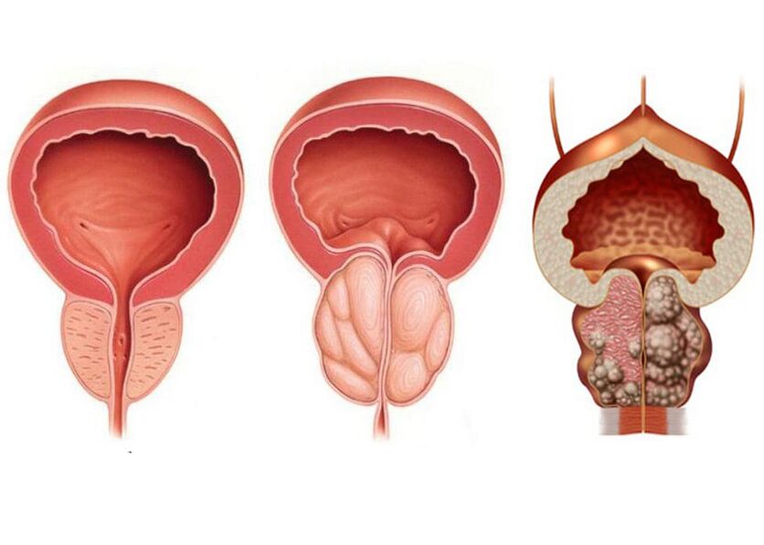 Stadien der Prostatitis und die Notwendigkeit einer Behandlung mit Prostavit