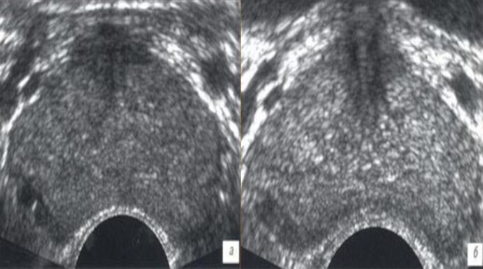 Ultraschall vor und nach der Behandlung mit Tropfen Prostovit