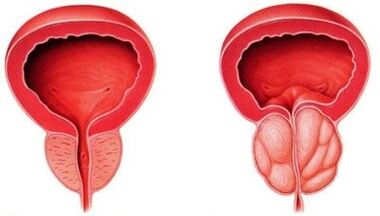 Gesunde und entzündete Prostata mit Prostatitis
